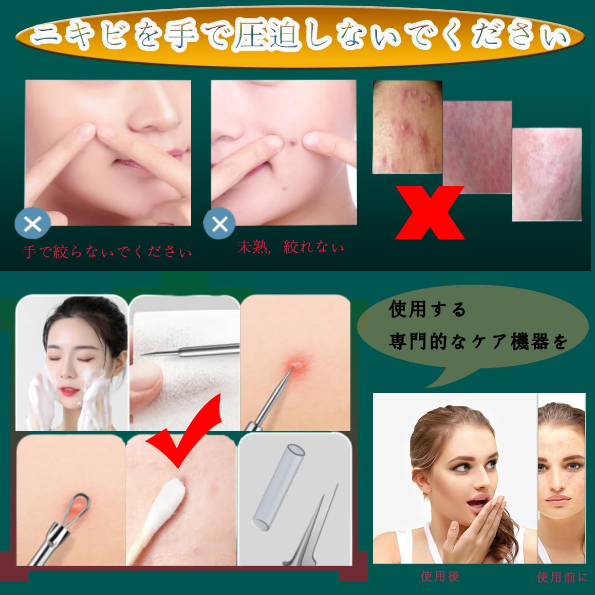 角栓ピンセット専用セット - 精密ピンセットで粉刺と黒ずみ精准去除!ニキビケアに最適、ステンレス鋼、超细尖头0.1mmで角栓取り&コメドプッシャー完璧毛穴ケア (8個セット)